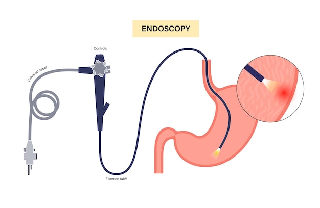 Procedimento de gastroscopia diagnóstico de doenças estomacais drge gastrite inflamação do trato digestivo gastroenterologista usa um conceito de endoscopia gastroscópica gastroenterologia problemas gastrointestinais