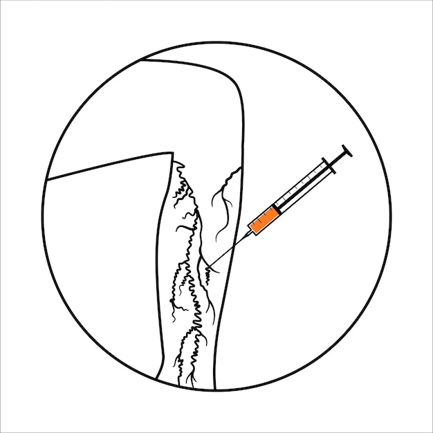 Vetor procedimento de injeção de varizes