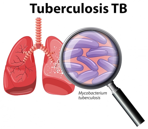 Pulmão humano com tuberculose