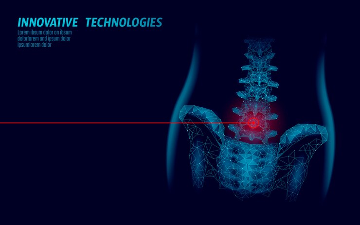 Vetor radiculite lombar da coluna vertebral humana dor baixo poli. triângulo de partículas poligonais geométricas ponto linha futura medicina tecnologia azul vermelho área dolorosa ilustração vetorial