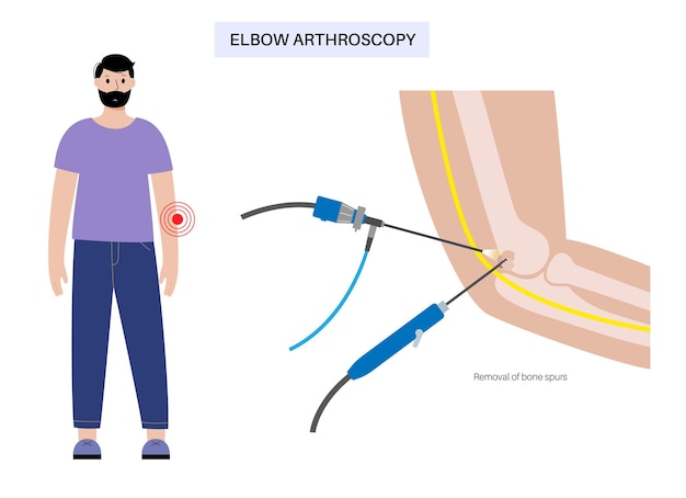 Vetor remoção do esporão ósseo articulação do cotovelo cirurgia minimamente invasiva artroscopia procedimento médico anatomia dos ossos do úmero, ulna e rádio dor no braço inchada e inflamação ilustração de raio x