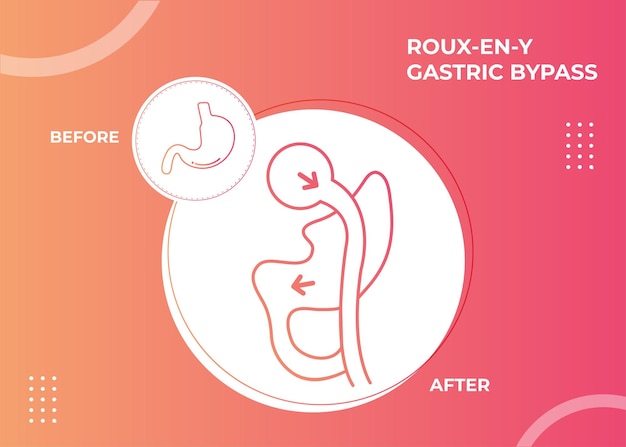 Roux-en-y gastric bypass (rny) ícone de ilustração vetorial de cirurgia para perda de peso