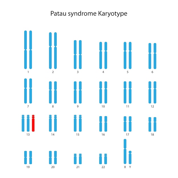 Vetor síndrome de patau trissomia 13 cariótipo humano masculino