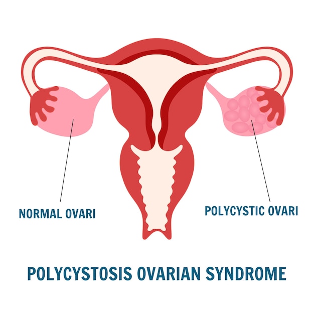 Síndrome dos ovários policísticos no sistema reprodutor feminino em ilustração vetorial