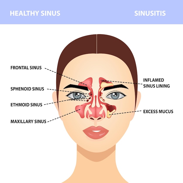 Sinusite. infecções saudáveis e sinusais, sinais, realistas