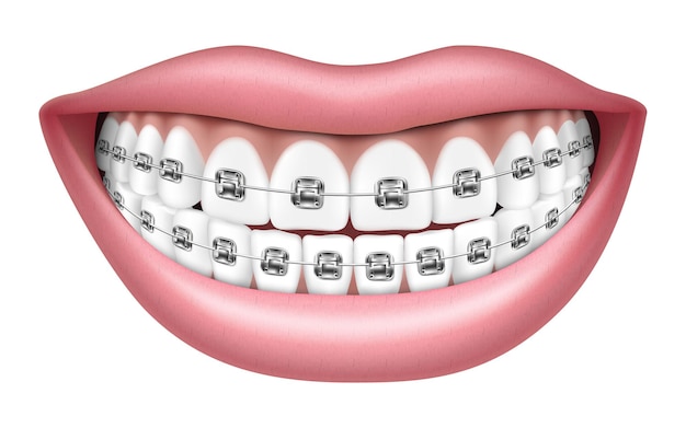 Vetor sorria com dentes e aparelho ortodôntico brancos. ilustração em vetor 3d realista, isolada no fundo branco,