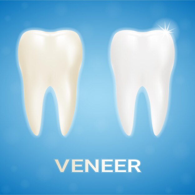 Técnico dental de clareamento de folheado de dente isolado em uma ilustração vetorial realista de fundo