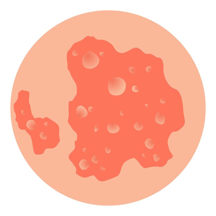Vetor tipo de vetor de psoríase parte da pele dos doentes com dermatite inflamação erupção vermelha e outra pele