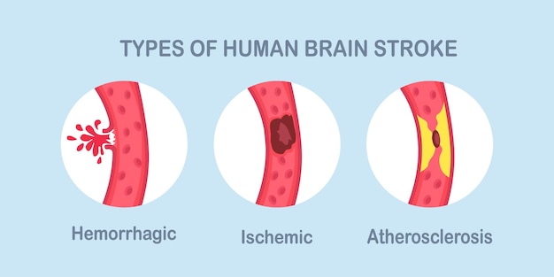 Vetor tipos de acidente vascular cerebral humano. doença isquêmica, aterosclerose e acidente vascular cerebral hemorrágico