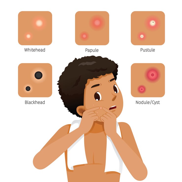 Vetor tipos de acne e pele bronzeada homem com acne no rosto