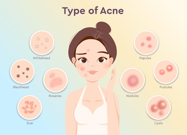 Tipos de acne em beleza mulher rosto ilustração