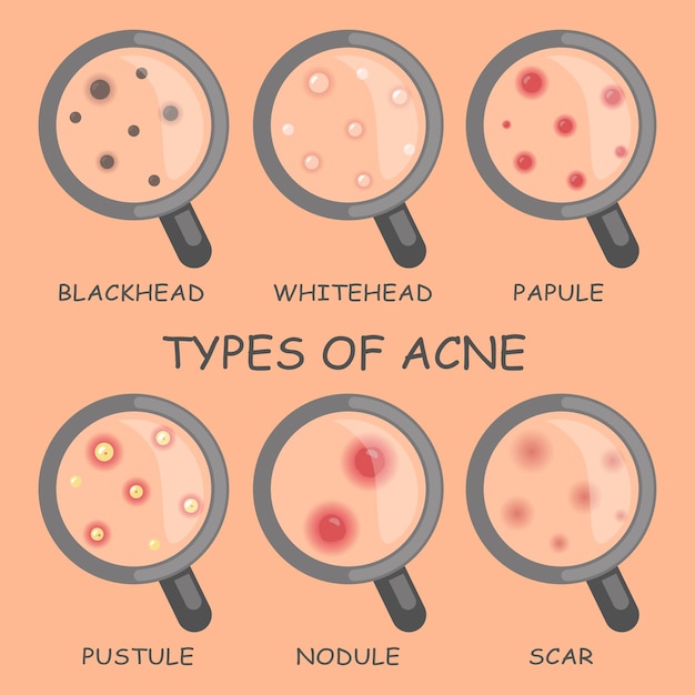 Vetor tipos de acne que aparecem na pele