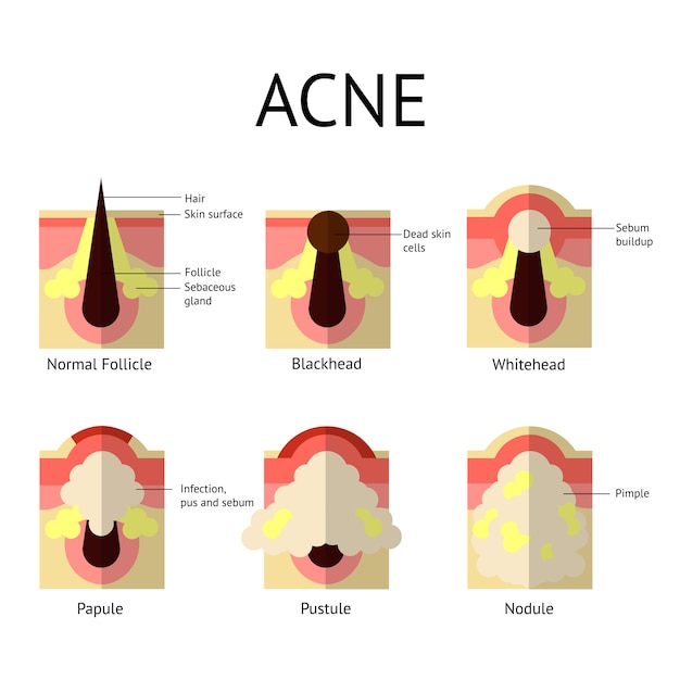 Vetor tipos de espinhas de acne. pele saudável, espinhas e cravos, pápulas e pústulas em estilo simples.