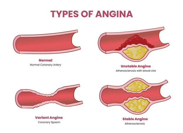 Tipos de ilustração de angina