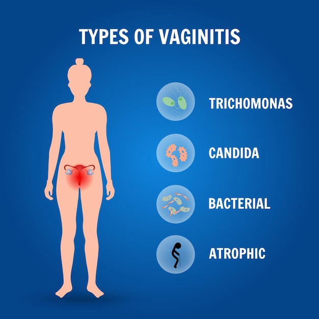 Vetor tipos de infográfico médico de vaginite em ilustração vetorial