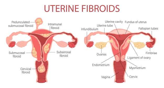 Tipos de miomas uterinos em mulheres. Miomas. Doenças do aparelho reprodutor feminino.