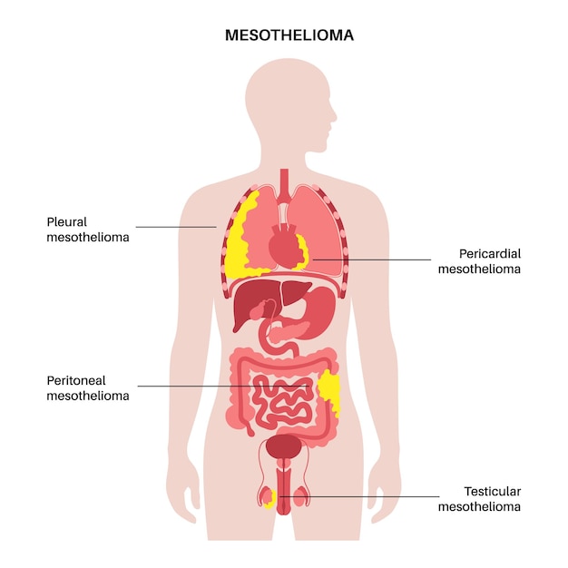 Tipos de tumor de mesotelioma