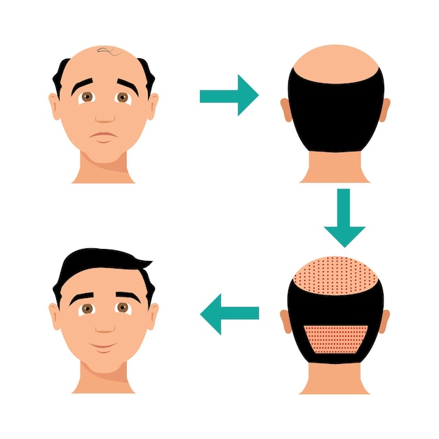 transplante de cabelo de vetor