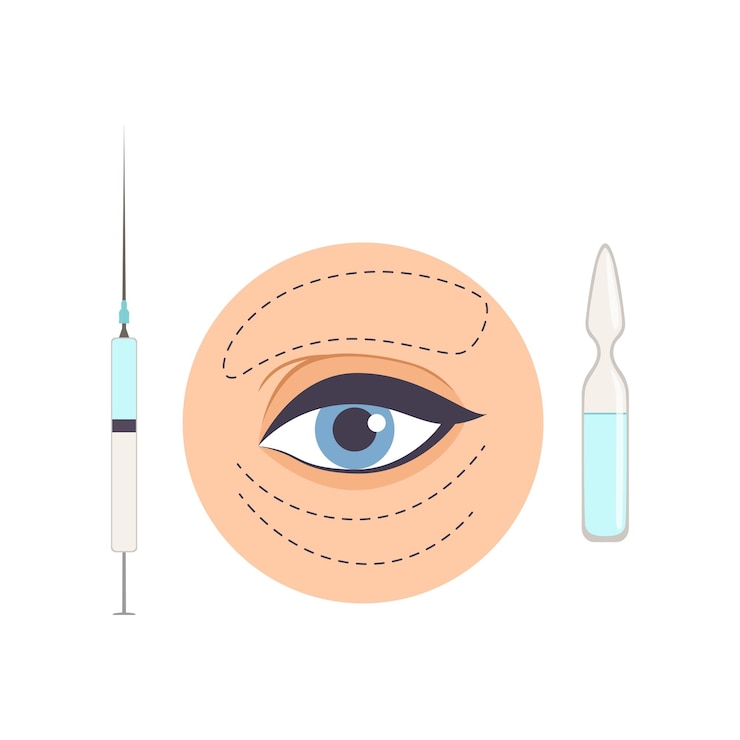 Vetor tratamento com ácido hialurônico de rugas simuladas sob os olhos procedimento cosmético de biorevitalização para