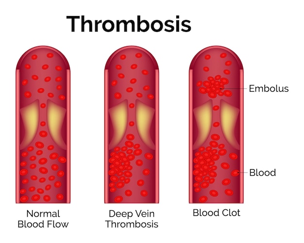 Vetor trombose fluxo sanguíneo normal trombose venosa profunda coágulo sanguíneo ilustração do vetor embolo sanguíneo