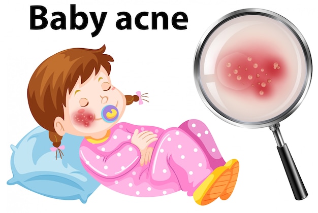 Vetor um bebê acne no rosto