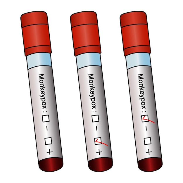 Um conjunto de tubos de ensaio com os resultados dos exames laboratoriais do sangue dos pacientes para o vírus da varíola dos macacos