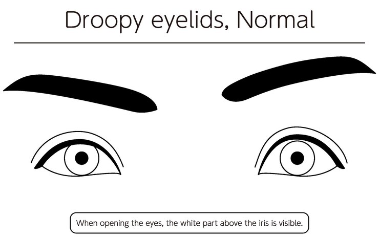 Vetor um desenho dos olhos de uma pessoa com as palavras pálpebras babadas, normal e normal.