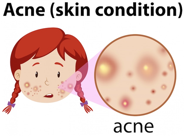 Um, menina jovem, tendo, acne