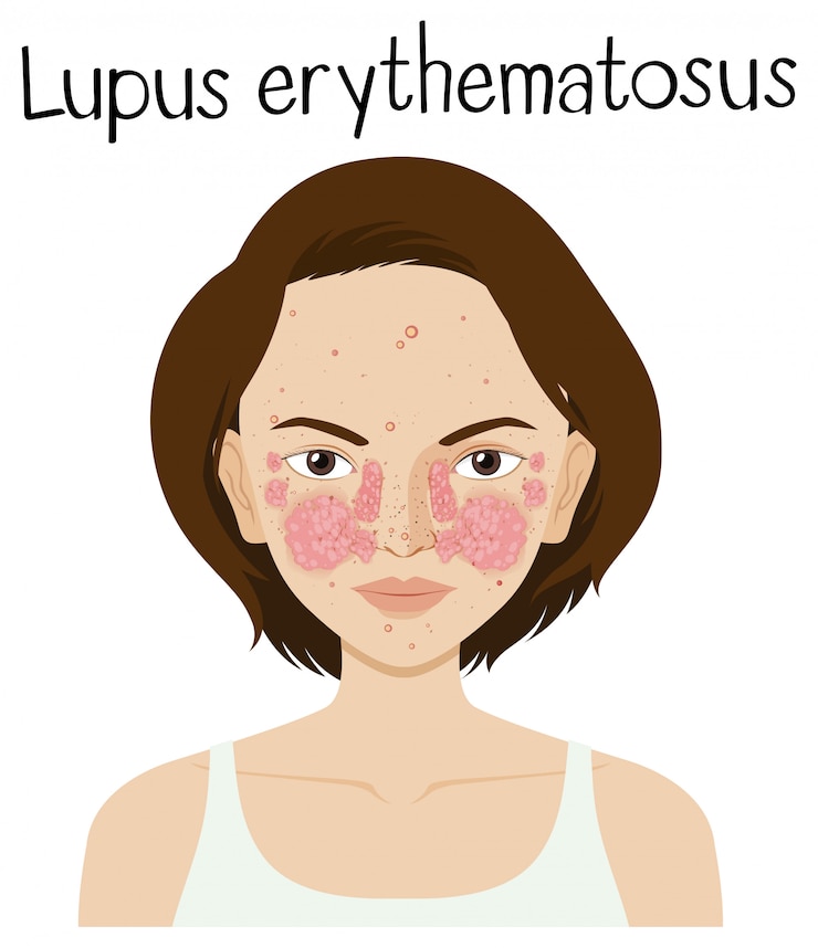 Vetor um vetor de lúpus eritematoso