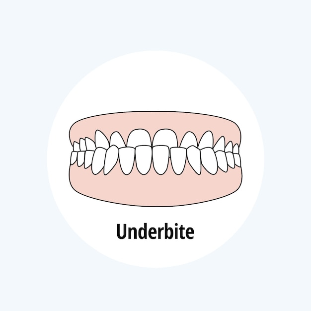 Underbite ilustração vetorial de problema odontológico Conceito de atendimento odontológico