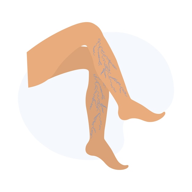 Vetor varizes nas pernas vascular ou vasinhos ilustração em vetor