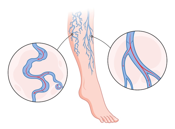 Vetor veias varicosas vaso sanguíneo azul visível através da pele perna anormalmente inchada diagnóstico e tratamento de doenças vasculares insuficiência venosa doença médica