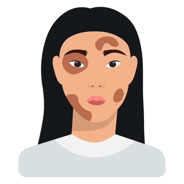 Vetor vetor de mulher com vitiligo