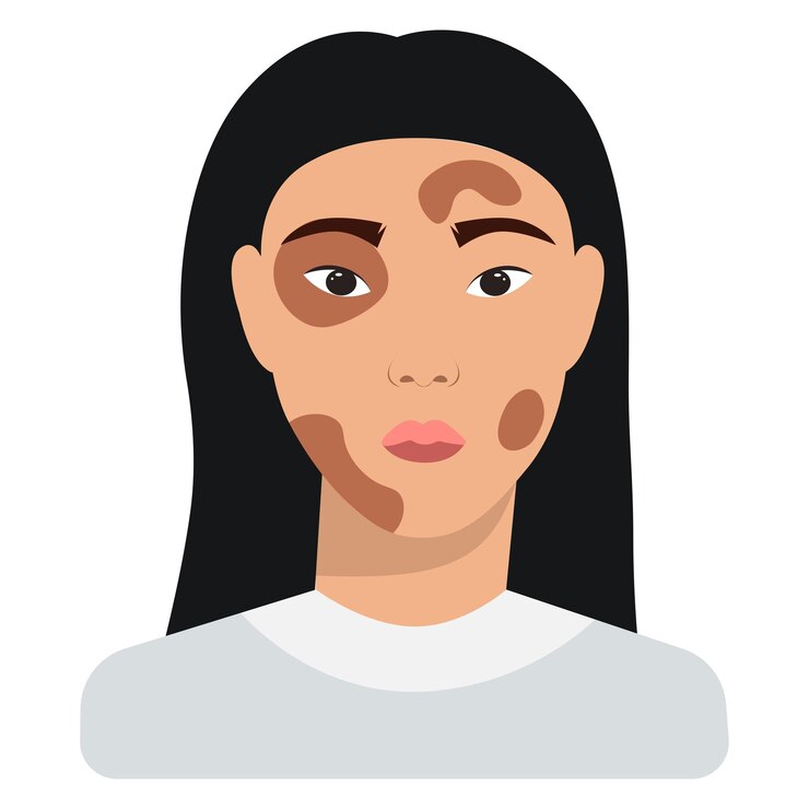 Vetor vetor de mulher com vitiligo
