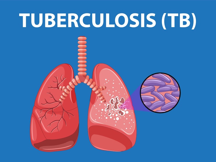 Vettore gratuito anatomia polmonare umana con tubercolosi infografica