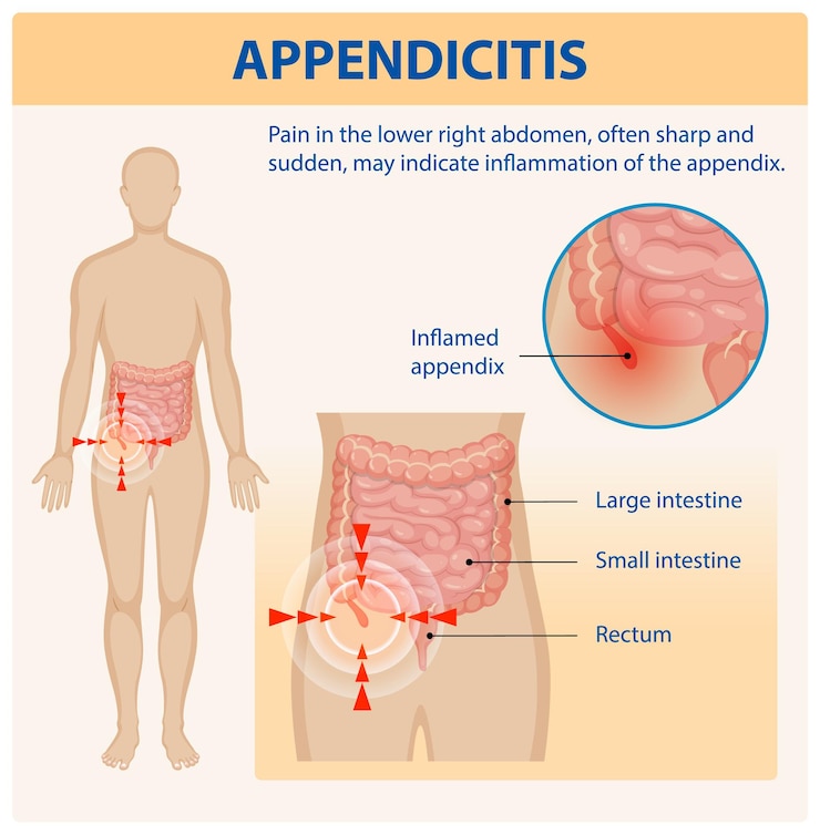 Vettore gratuito comprendere l'appendicite e i suoi sintomi