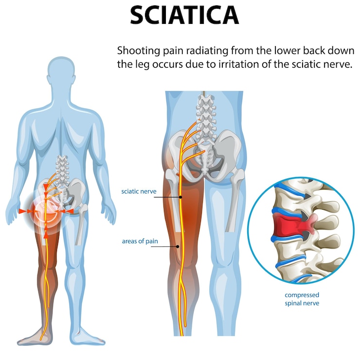 Vettore gratuito comprendere la sciatica e i suoi sintomi