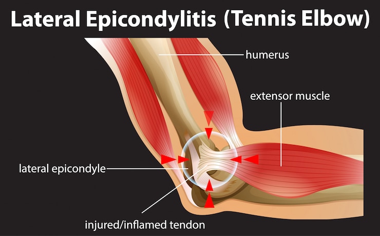 Vettore gratuito epicondilite laterale o gomito del tennista