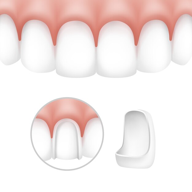 Faccette dentali di vettore su denti umani isolati su priorità bassa bianca