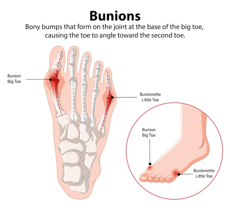 Vettore gratuito illustrazione di bunions e bunionette