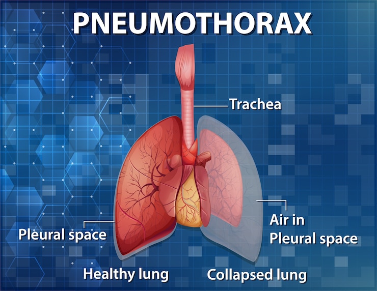 Vettore gratuito illustrazione informativa del pneumotorace