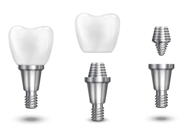 Impianto dentale. Impianto dentale e dente di salute, impianto sano, illustrazione vettoriale