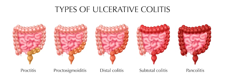 Vettore gratuito infografica sui tipi di colite ulcerosa