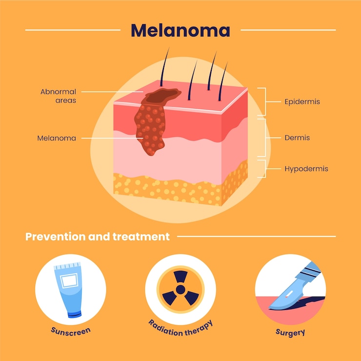 Vettore gratuito infografica sul melanoma dal design piatto disegnato a mano