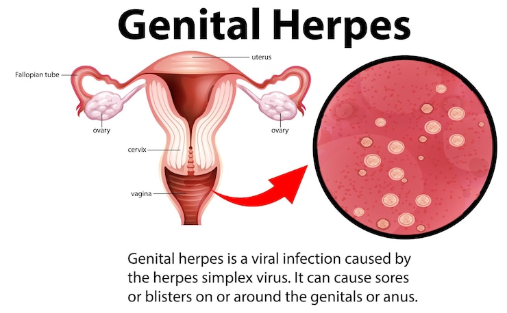 Vettore gratuito infografica sull'herpes genitale con spiegazione