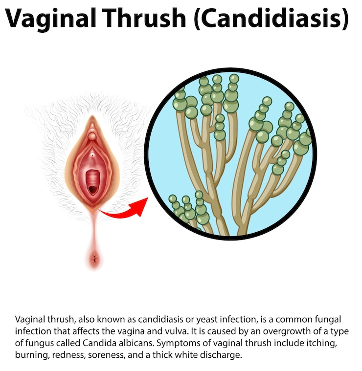 Vettore gratuito infografica sulla candidosi del mughetto vaginale con spiegazione
