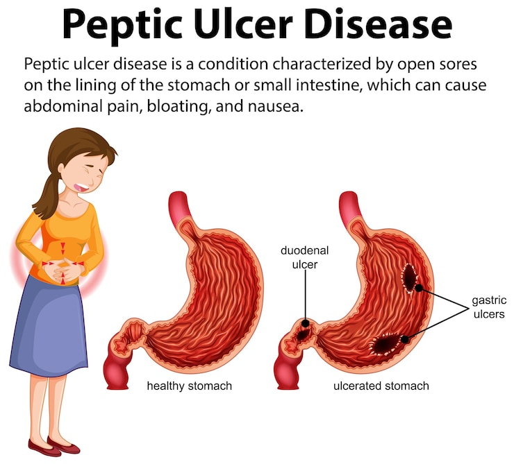 Vettore gratuito infografica sulla malattia dell'ulcera peptica