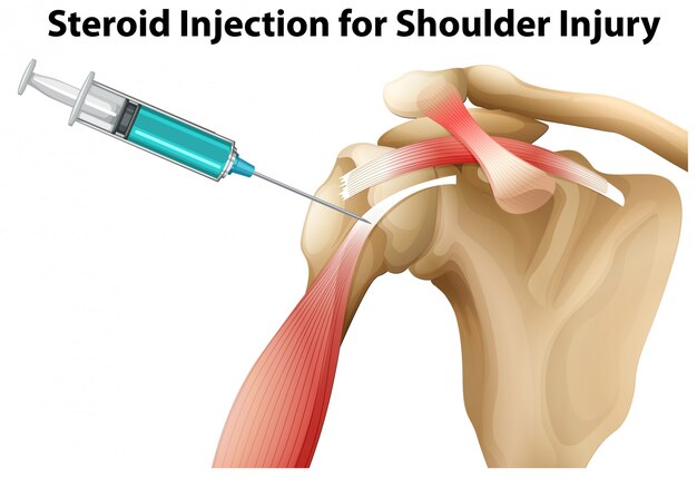 Iniezione di steroidi per lesioni alla spalla