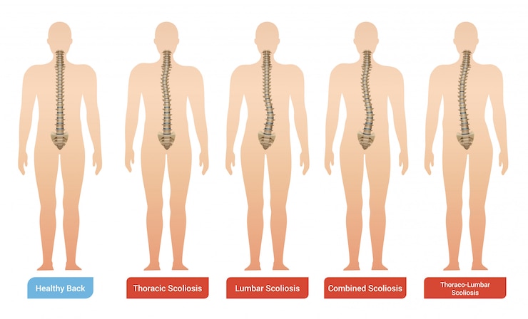 Vettore gratuito le immagini infographic mediche di scoliosi di curvatura spinale hanno messo con le siluette del corpo umano con la spina dorsale e il testo