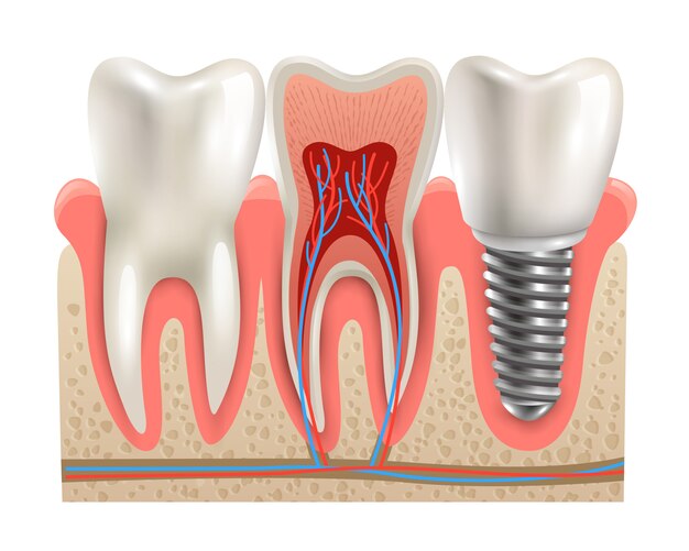 Modello del primo piano di anatomia degli impianti dentali